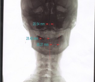 On birthdays, one’s health and a pain in the neck…